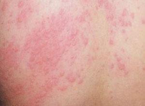 湿疹吃云南小瓜,天然食材缓解肌肤不适